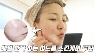 광고X 정말 매일하는 여드름 스킨케어 루틴+판토텐산 최근 후기