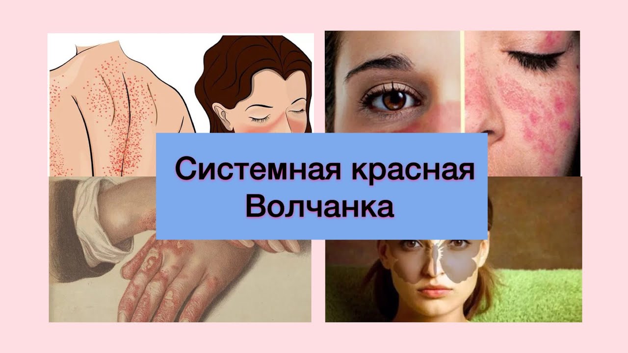 Системная Красная Волчанка не приговор! Лечение СКВ в Бразилии - YouTube