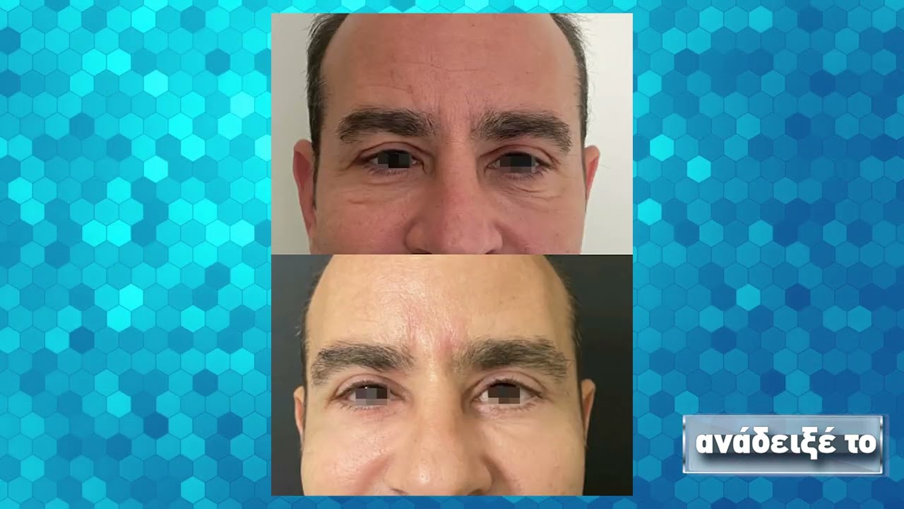 Δρ Παπασταύρου Αλέξανδρος- Όσα πρέπει να ξέρετε για την Βλεφαροπλαστική