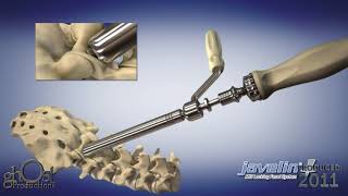 US Spine Javelin
US Spine Javelin US Spine Javelin