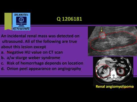 Renal angiomyolipoma- Classical radiological features