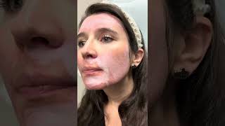 Dr. B Shows How To Do A 23% Tca Peel On Pregnant Woman