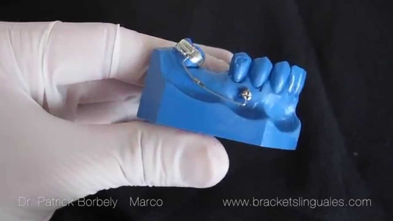 BIOMECÁNICA CON MINI IMPLANTES # 2 (VERTICALIZACIÓN Y EXTRUSIÓN DE MOLARES)