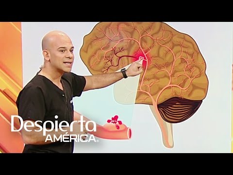 La aneurisma por que produce cerebral se