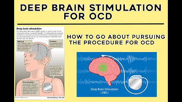Deep Brain Stimulation For OCD – How To Pursue The Procedure/How To Get DBS For OCD
