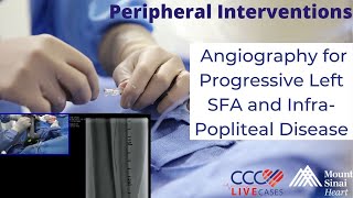 Angiography for Progressive Left SFA and Infra-Popliteal Disease - Peripheral - Sept 2016