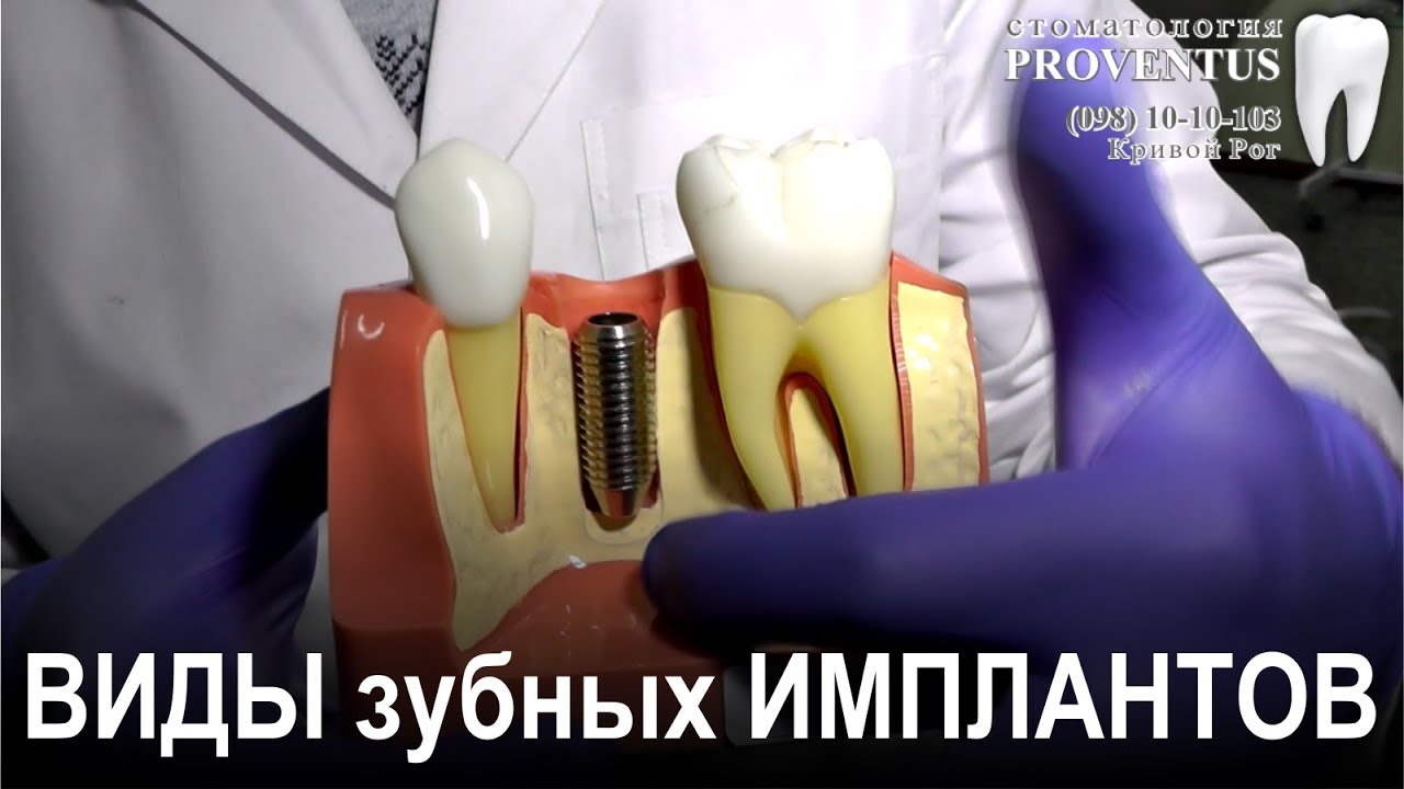 Импланты зубов: виды и какие применяют в клинике Провентус, Кривой Рог ...