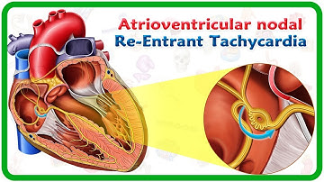Atrioventricular nodal re-entrant tachycardia (AVNRT) / USMLE