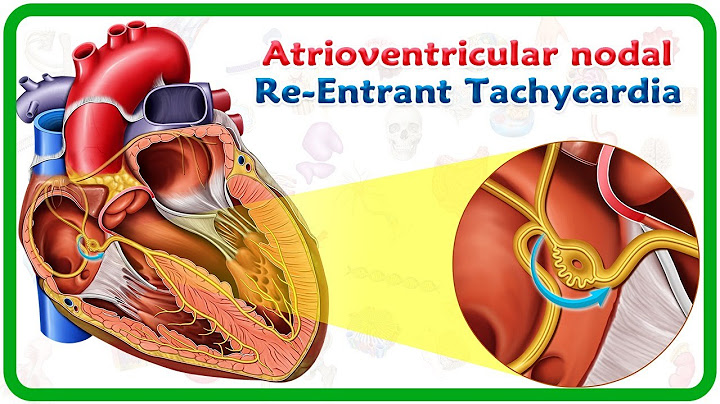 Atrioventricular re-entrant tachycardia tiếng việt là gì năm 2024