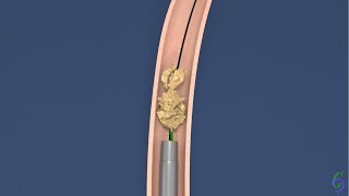 Ureterolitotripsia Rigida - Animação cirurgia de pedra no ureter - Tratamento de cólica renal