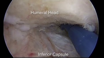 Comprehensive Arthroscopic Management | Treatment of Shoulder Osteoarthritis | Shoulder Surgeon
