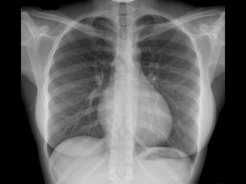 Guide pratique pour la réalisation de la radiographie du thorax