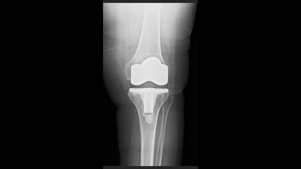 Diz protezi ameliyatından sonra sık sorulan sorulara cevaplar