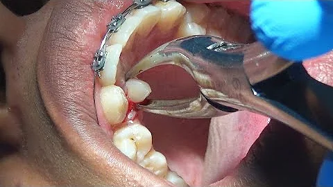 Porque nasce dentes no céu da boca?