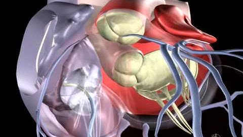 Animated Example of Lead Placement in Heart Failure Device CRT