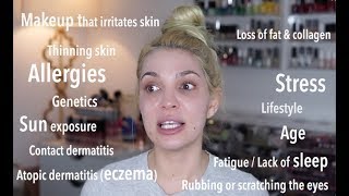 DARK CIRCLES – Treatment + Makeup Tricks