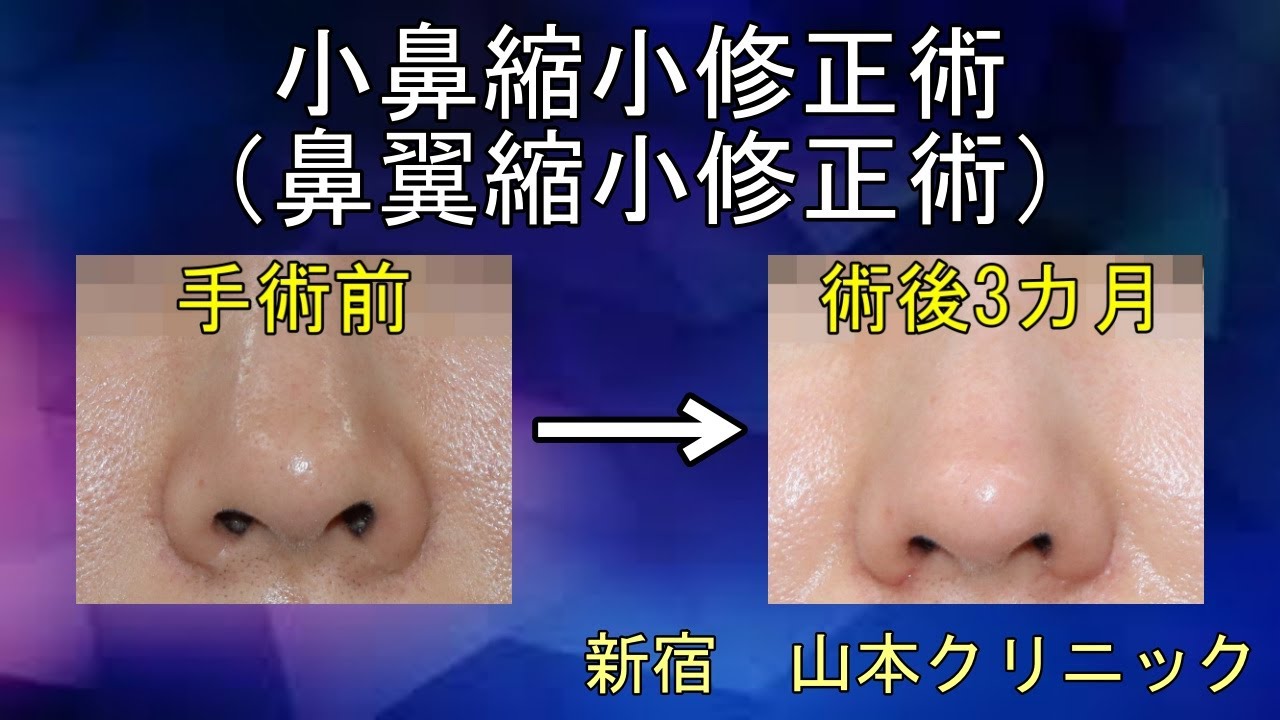 小鼻縮小後の左右差を治す 治せる Youtube 小鼻縮小後の左右差を治す 治せる Youtube