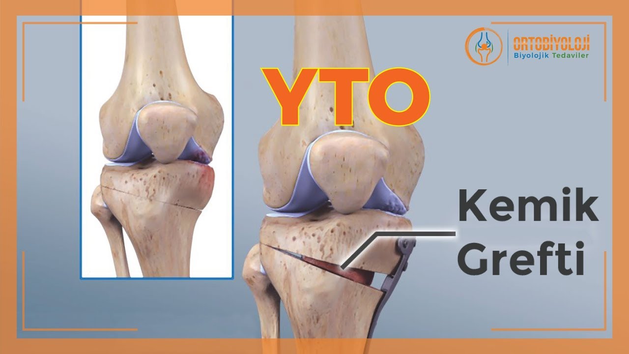 YÜKSEK TİBİAL OSTEOTOMİ TEDAVİSİ YouTube