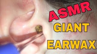 EAR WAX REMOVAL ASMR