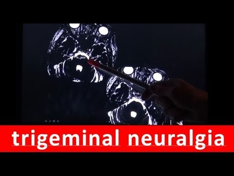 What Trigeminal Neuralgia Ms