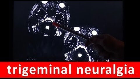 Trigeminal neuralgia, hyperactive dysfunction of the trigeminal nerve, english by Radiology TV