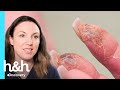 Paciente acorda de noite com as mãos ardendo | Dra. Emma: Uma Questão de Pele | Discovery H&amp;H Brasil