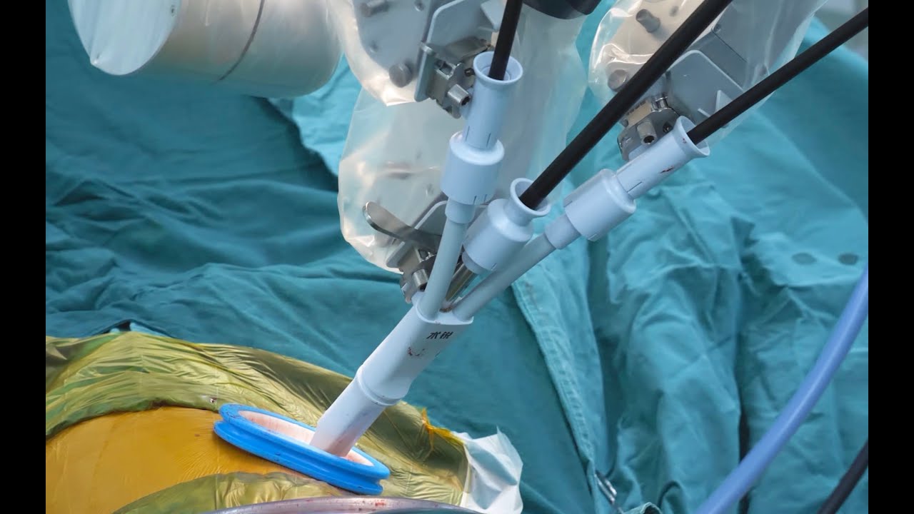 First sleeve lobectomies performed with a single port robotic platform ...