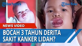 KISAH NABILLA Bocah 3 Tahun Derita Penyakit Seperti Kanker Lidah