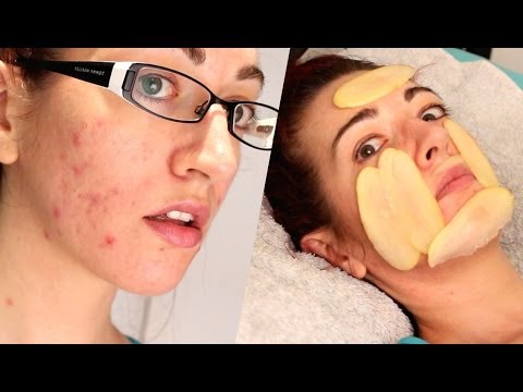 ✔ HOW TO: FADE ACNE SCARS WITH... POTATO?! Natural Mild Scarring Treatment!