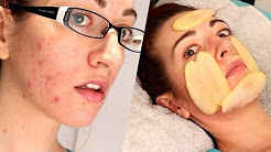 ✔ HOW TO: FADE ACNE SCARS WITH. POTATO?! Natural Mild Scarring Treatment!