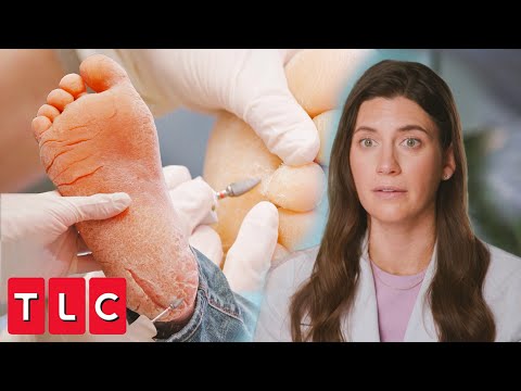 Incredibly Deep Fissures: Dr. Sarah Breaks Out the Medical Dremel | My Feet Are Killing Me