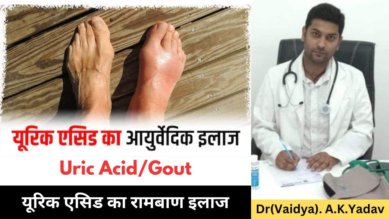 यूरिक एसिड का आयुर्वेदिक इलाज। Uric Acid Treatment in Ayurveda