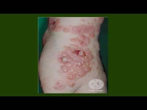 Video: Pemphigoid Gestationis: Kuvat, Oireet, Hoito Ja Syyt