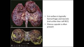 Renal Tumor Pathology Case 4