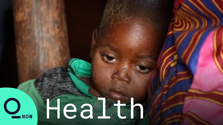 Measles Surge in DRC, Surpassing Covid-19 Deaths