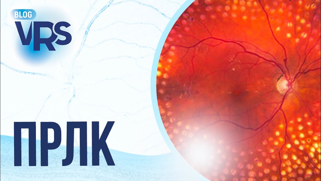 Сахарный диабет / Диабетическая ретинопатия / Панретинальная лазеркоагуляция