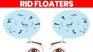 Eye Floaters: What Are They \& How to Get Rid of Them