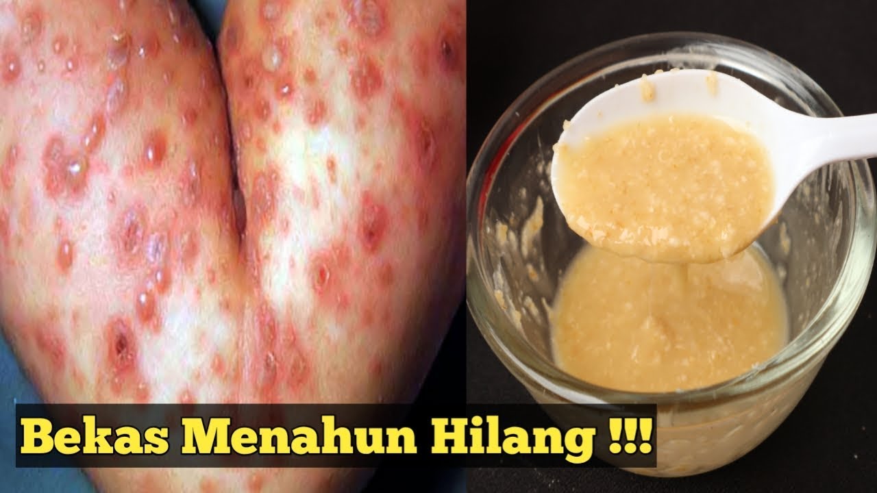 Cara Cepat Menghilangkan Bekas Cacar Menahun Mudah Dan Efektif