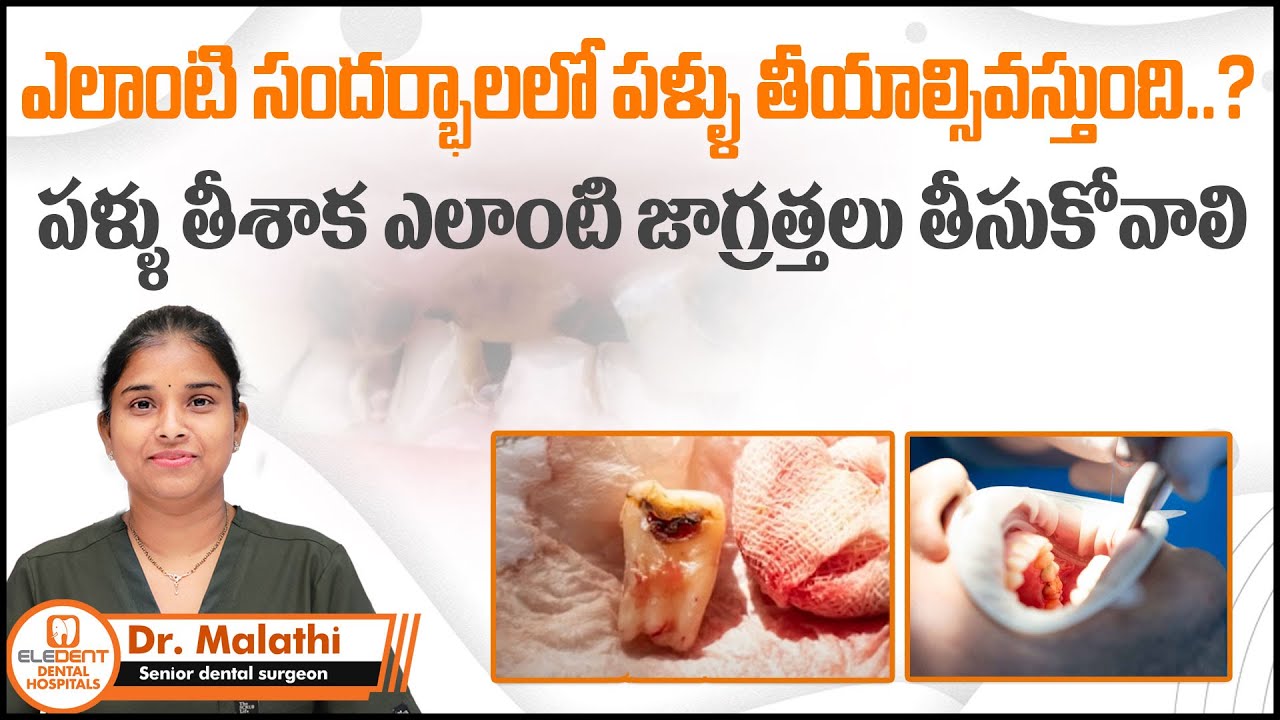 Best Tips for Fast Recovery After Tooth Extraction | Tooth Removal Care in Telugu | Dental tips