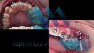 Planificación De Minitornillos Infracigomáticos Izc Tads Con