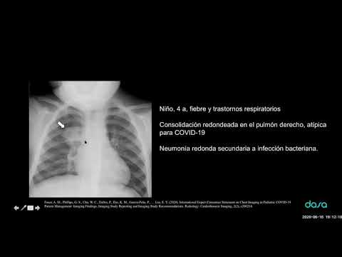 Video: Que día hacer una tomografía computarizada para el coronavirus