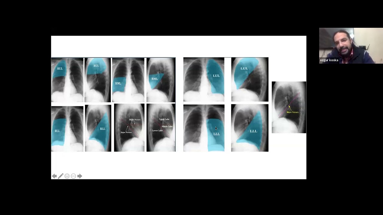 Çocuk Acil Servis'te Akciğer Grafisi Yorumlama İpuçları-Part 1