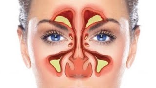التهاب الجيوب الأنفية الحاد.. اسباب و أعراض و طرق الوقاية.. شاهدوا الفيديو للآخر