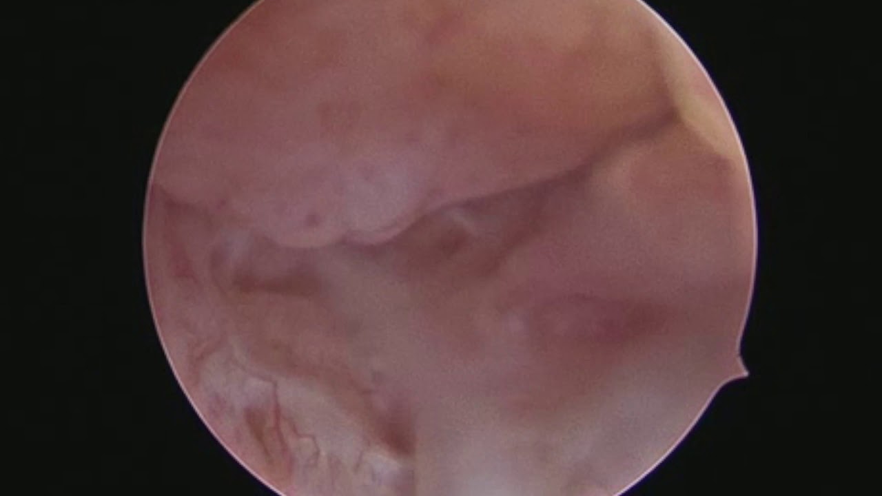 isteroscopia nella paziente infertile  by Eleonora Castellacci Ginecologia Isteroscopia