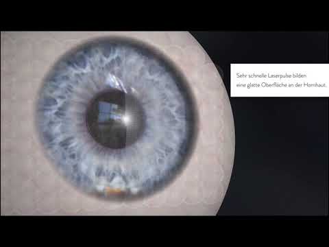 Z-Lasik – Augenchirurgie der 2. Generation