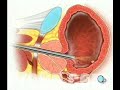 PreOp® Patient Education Cystoscopy via Penis, Male Surgery