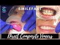 Composite Veneers For Gaps | TASHA'S SMILEFAST TRANSFORMATION!