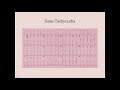 Tachyarrhythmias - CRASH! Medical Review Series