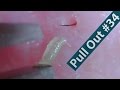 #34 Pull Out Blackheads Close up - Blackheads Removal