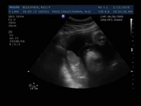 Kelly's last sonogram